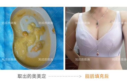 探讨乳房填充物取出术的潜在风险与安全性